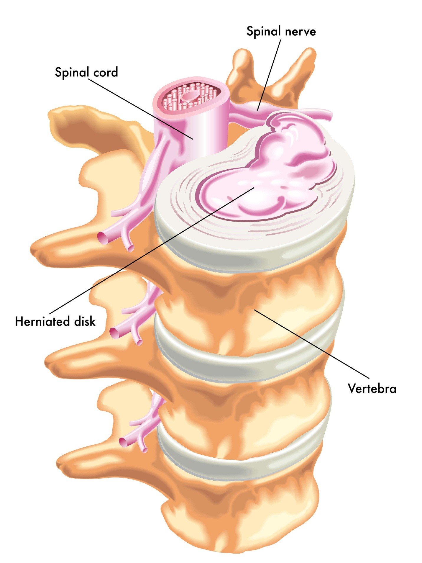 thoát vị đĩa đệm 2