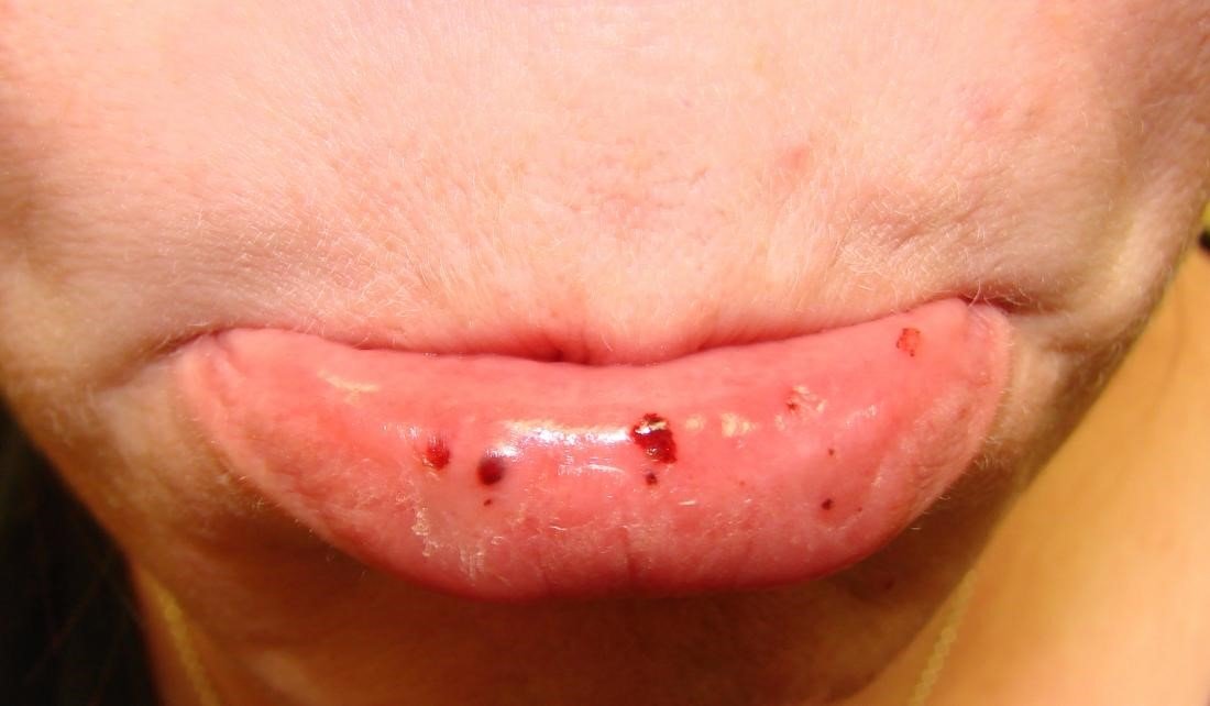xuất huyết giảm tiểu cầu 3
