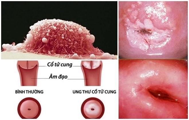 ung thư cổ tử cung 1