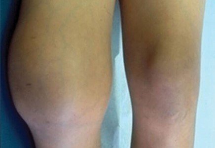 bệnh máu khó đông 1
