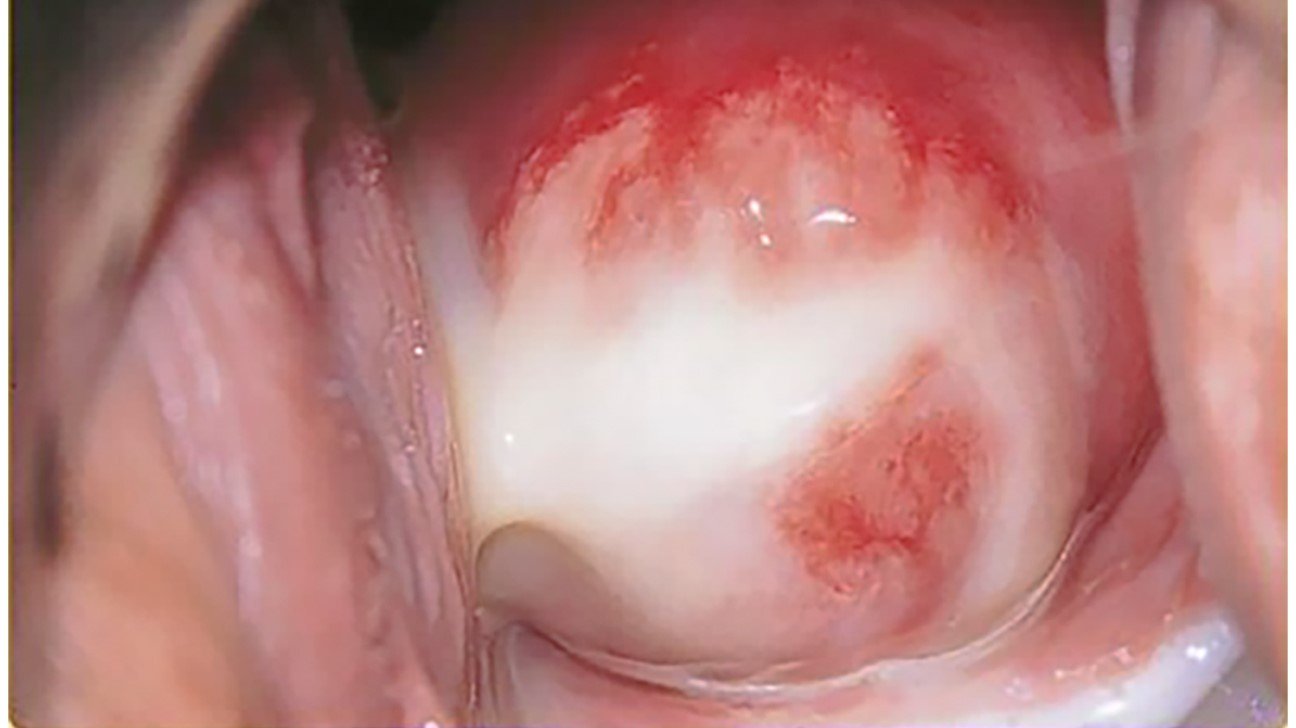 nhiễm lậu cầu 3