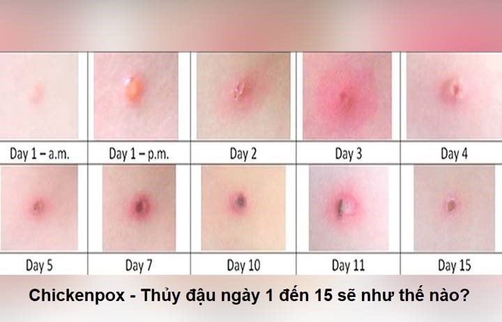 thủy đậu