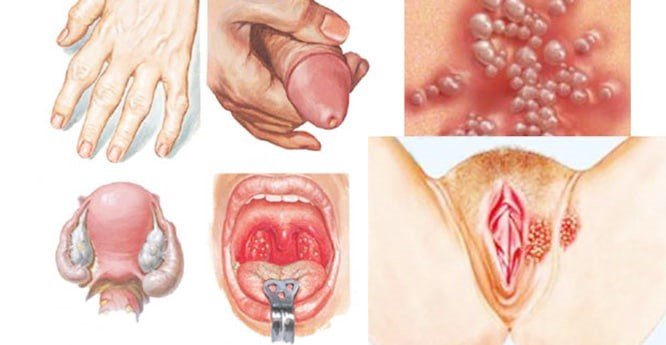 nhiễm lậu cầu 4