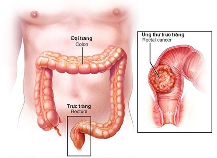 ung thư đại tràng 3