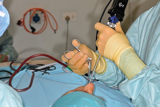 Polyp mũi 4