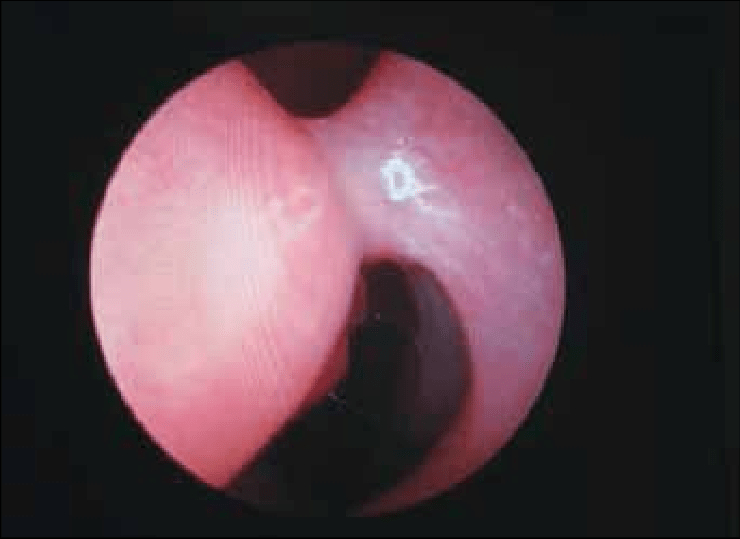Polyp mũi 4
