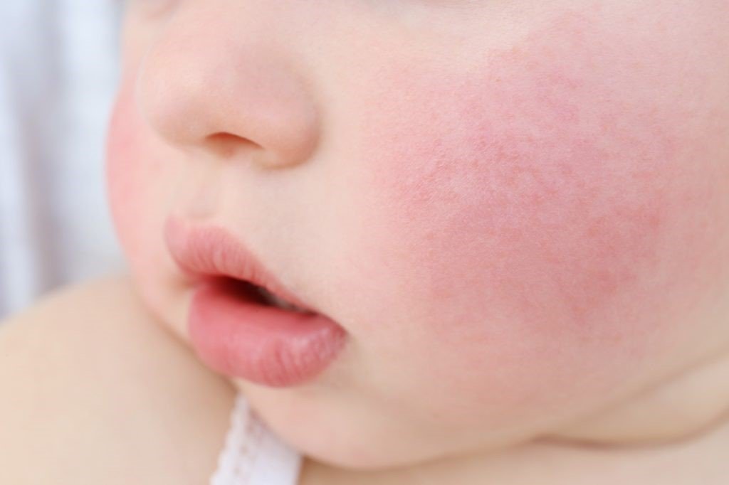Nổi ban đỏ ở da sau khi trẻ bú sữa bò