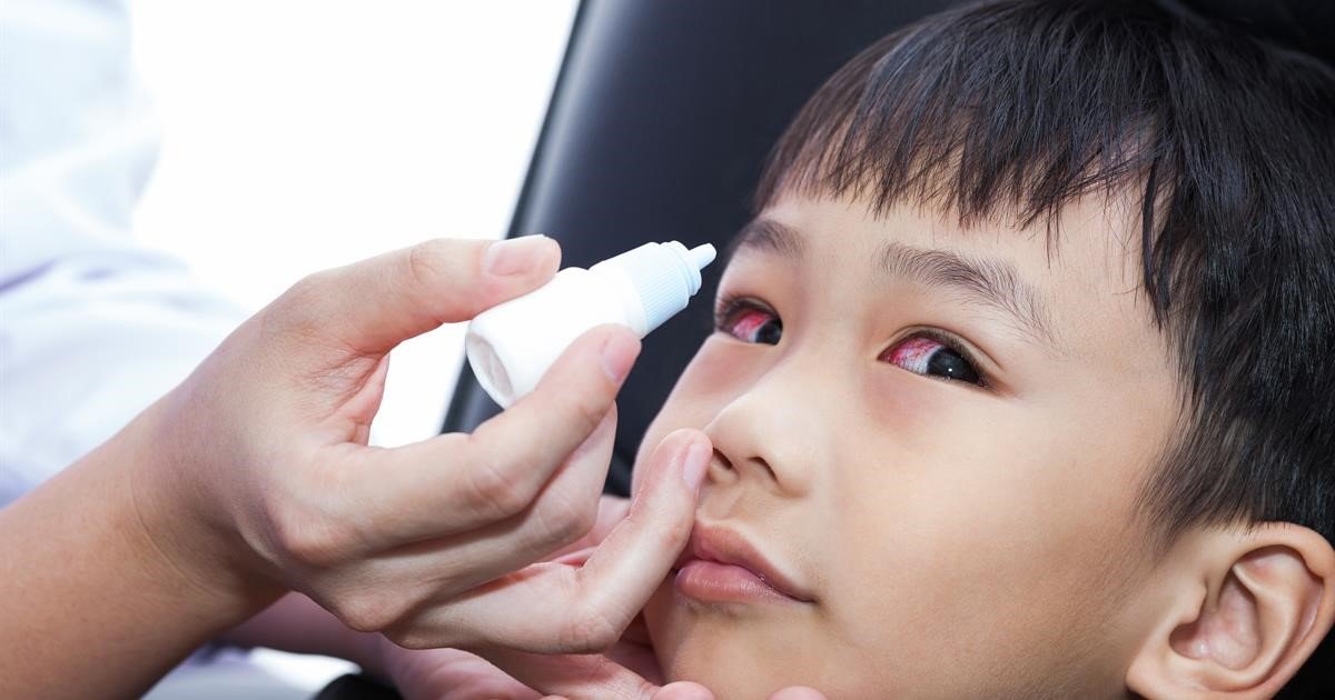 viêm kết mạc 1