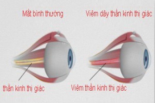thần kinh thị giác 2