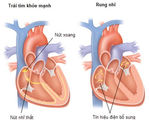 rung nhĩ 1