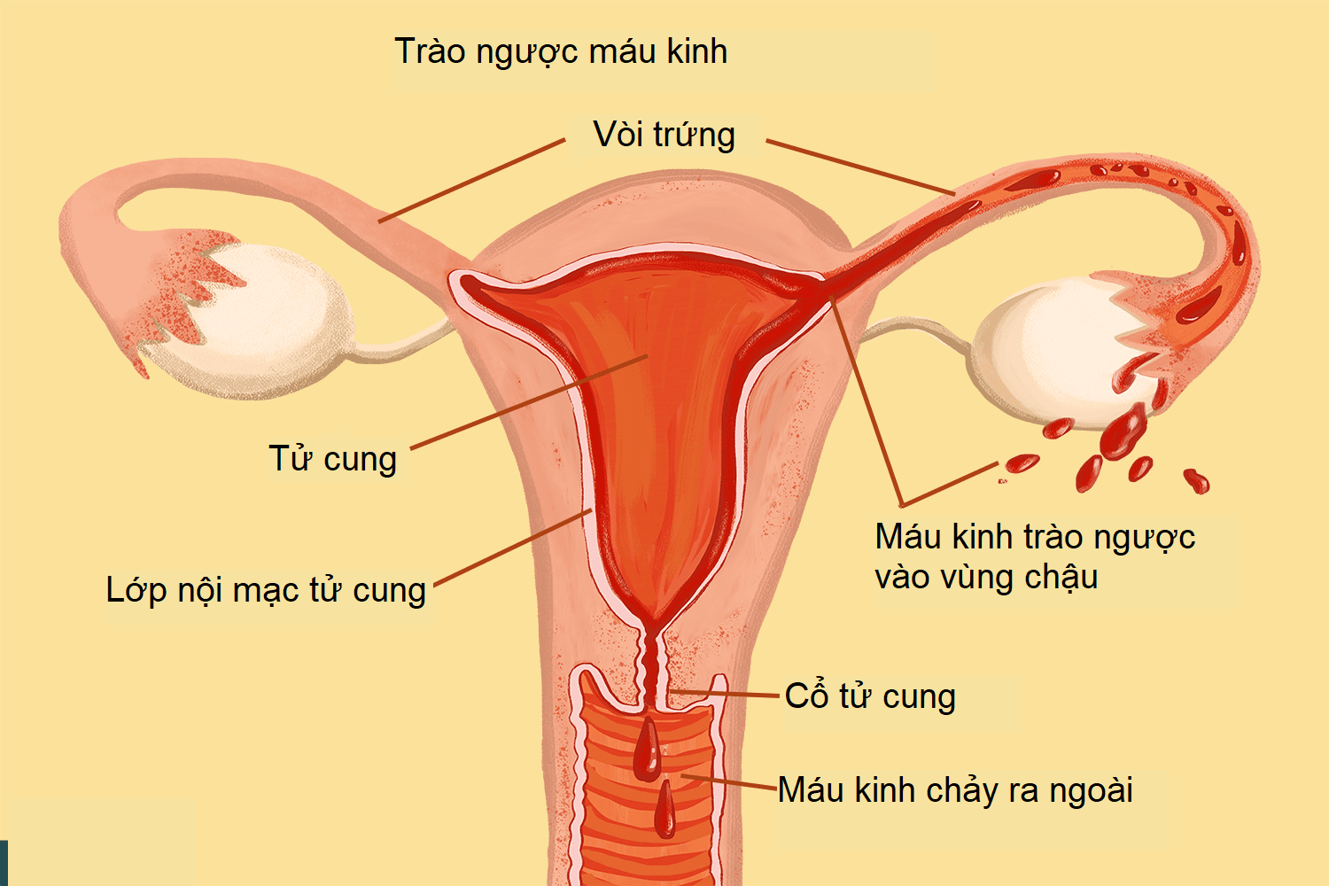 nội mạc tử cung 3