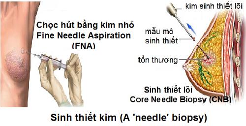 ung thư vú 5