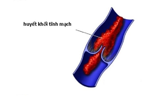 viem-tinh-mach-huyet-khoi-moi-hiem-hoa-bat-ngo